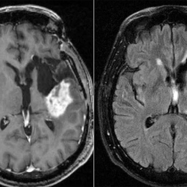 Chemo for glioblastoma may work better in morning than evening